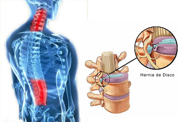Hernia de disco sintomas